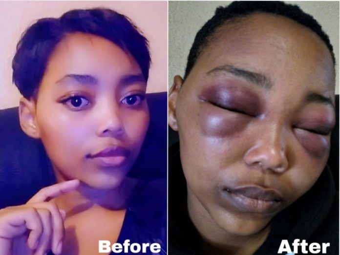 Ntokozo is horrified that ex-boyfriend who got bail after damaging her face might go after her